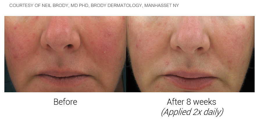 Triple Antioxidant Cream/Serum Before and After